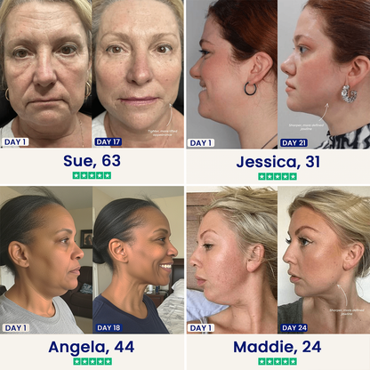Ovornix™ Double Chin Lifting Mask